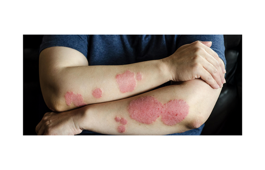 Lactobacillus Probiotic Strains: Evaluating Their Impact on Atopic Dermatitis in Children
